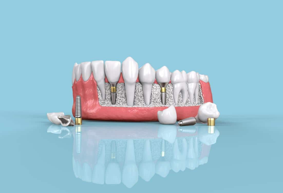 Dental Implant Restorations in little River Dr. Emily Hortman, DMD. General Dentist, Cosmetic, Restorative, Preventative, Family Dentist, Dental Implants, TMJ/TMD, Emergency Dentistry, Crowns & Bridges, Teeth Whitening, Sleep Apnea Appliances, Sedation dentistry, Invisalign, Teeth Whitening, Dental Implant Restoration, Veneers, Emergency Dentistry, Dentures, Extractions, Root Canal Therapy . Dentist in Little River, SC 29566 Top-notch dentist in Little River, SC 29566