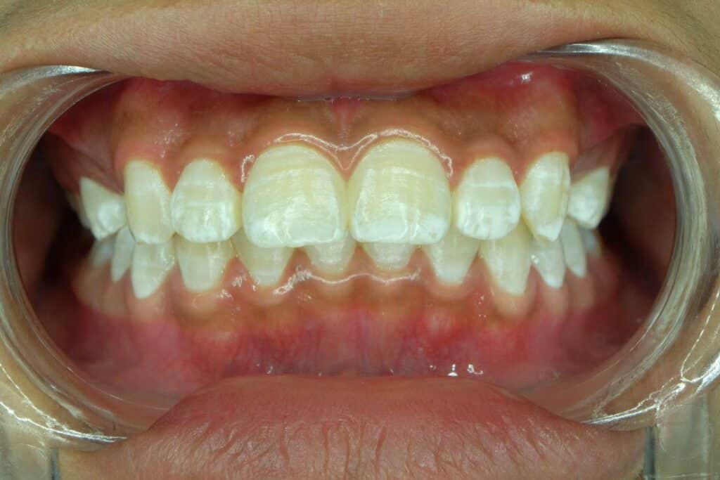 Dr. Emily Hortman, DMD. General Dentist, Cosmetic, Restorative, Preventative, Family Dentist, Dental Implants, TMJ/TMD, Emergency Dentistry, Crowns & Bridges, Teeth Whitening, Sleep Apnea Appliances, Sedation dentistry, Invisalign, Teeth Whitening, Dental Implant Restoration, Veneers, Emergency Dentistry, Dentures, Extractions, Root Canal Therapy . Dentist in Little River, SC 29566 Top-notch dentist in Little River, SC 29566
