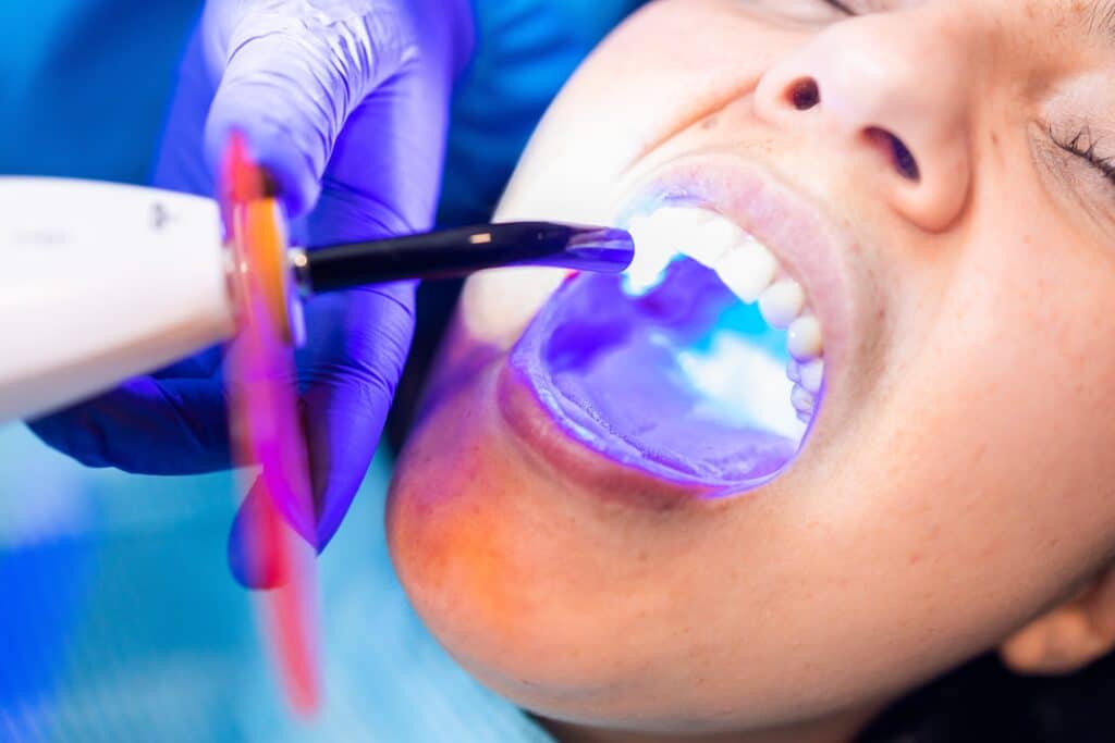 Dental Fillings Little River
