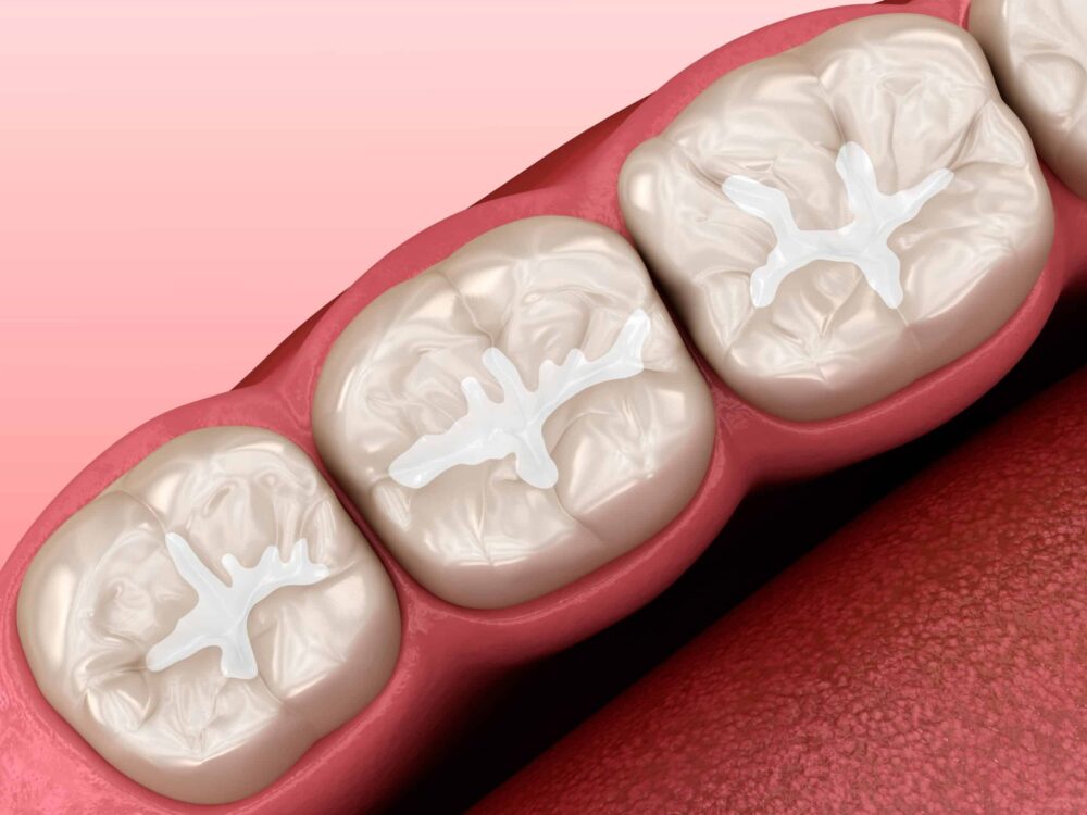 Dental Sealants Little River
