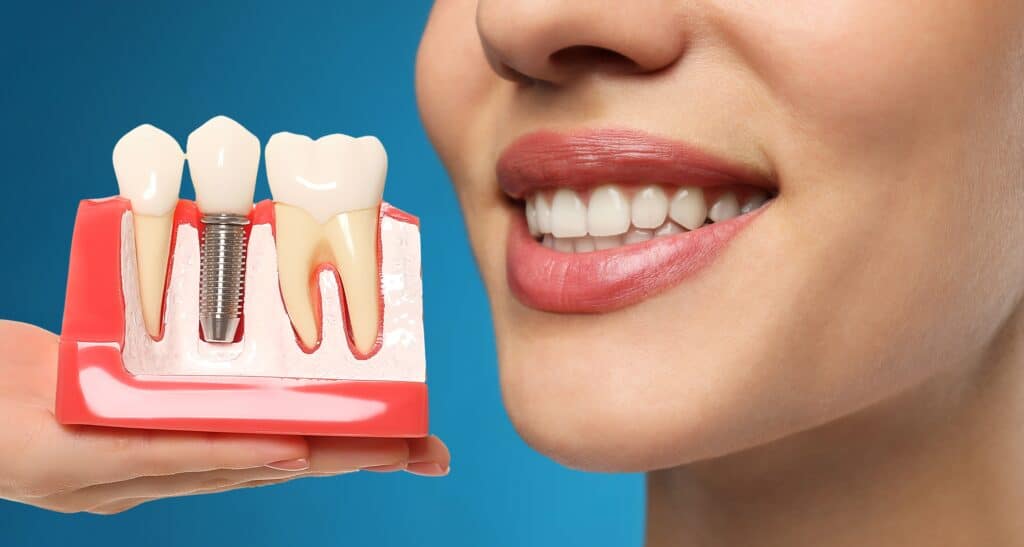 Dental Implants Little River