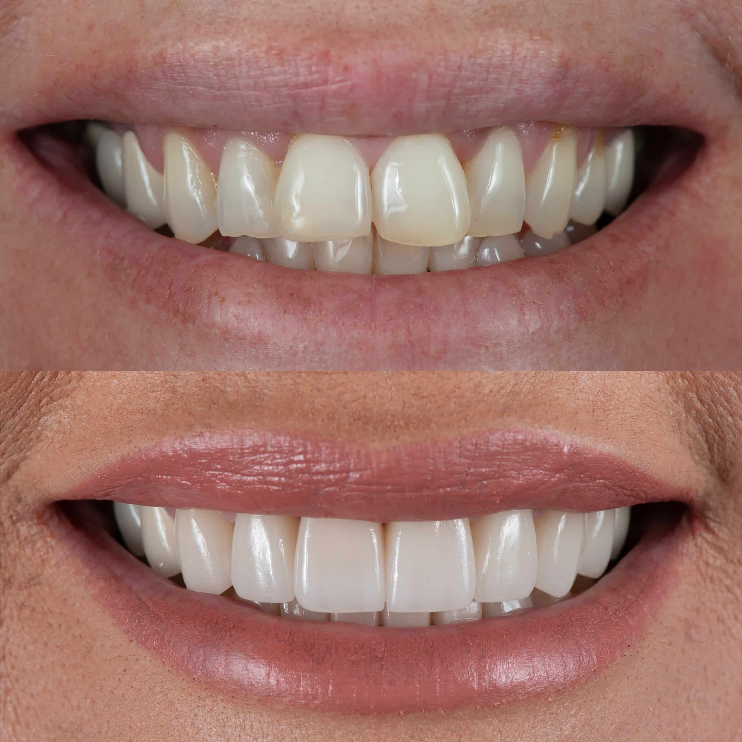 Smile Makeovers in Little River